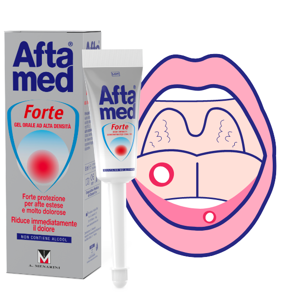 aftagelforte Aftamed gel orale forte primo piano, in secondo piano bocca con afte